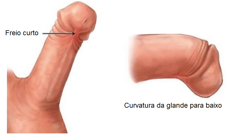 Penis Curvatura.